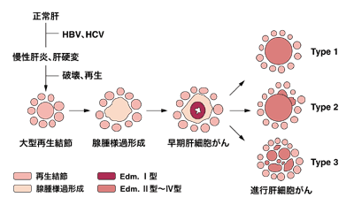図：肝細胞がんの多段階発育
