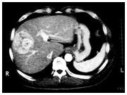 CT検査で見た肝臓がん