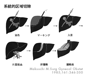 系統的区域切除
