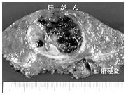 肝臓がんの多くは、慢性肝炎、肝硬変を母地に起こってくる