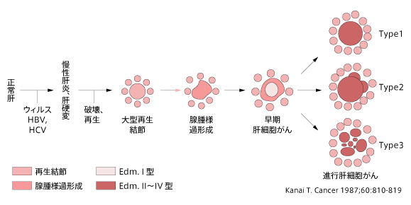 肝臓がんの多段階発育
