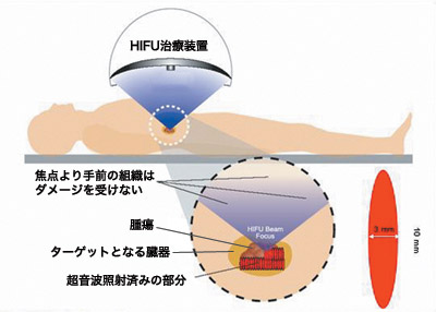 図:HIFUの照射