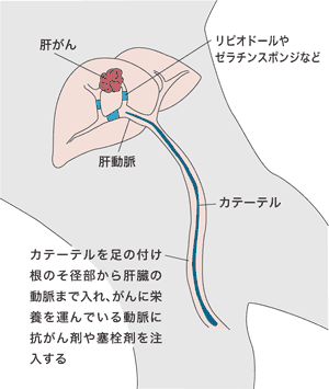 図:肝動脈(化学)塞栓療法(TACEまたはTAE)