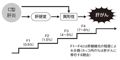 F1～F4とは肝線維化の程度による分類