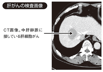 肝がんの検査画像