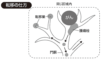 転移の仕方