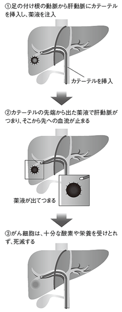 肝動脈塞栓療法の方法