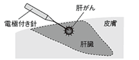 ラジオ波焼灼療法の方法