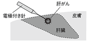 ラジオ波焼灼���法の方法