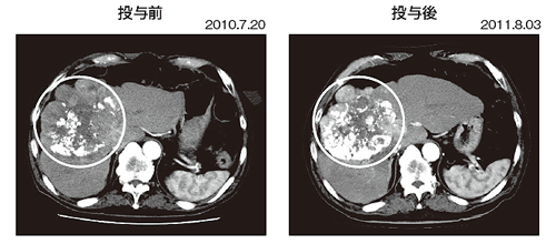 写真3 症例（70歳 男性）CT画像