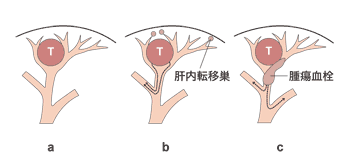 門脈をたどって起こる肝内転移