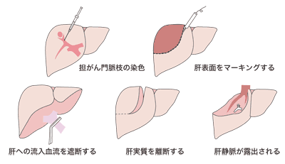 幕内医師により編み出された、系統的区域切除