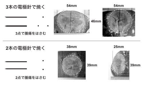 治療前、治療後のCT画像