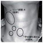 甲状腺乳頭がんとリンパ節転移が起こっている例