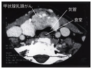 乳頭がんが気管に浸潤している例（頸部CT画像）。気管が変形している