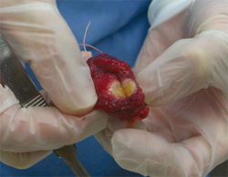 写真:摘出した甲状腺の右葉