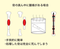 軟骨肉腫のMRI画像