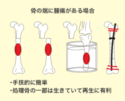軟骨肉腫のMRI画像