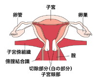 図：円錐切除術