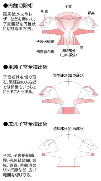 子宮頸がんの手術の種類