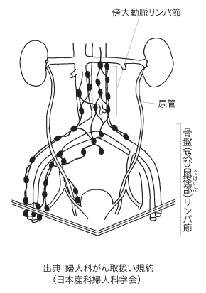 婦人科がんに関連するリンパ節