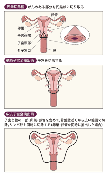 図：3大手術方法