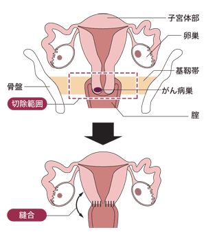 図:広汎性子宮頸部摘出術の方法
