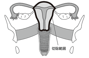 単純子宮全摘出術
