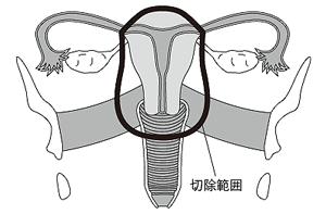 準広汎子宮全摘出術