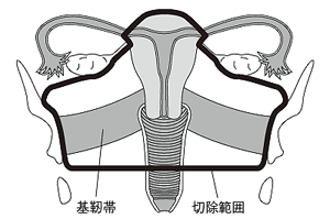 広汎子宮全摘出術