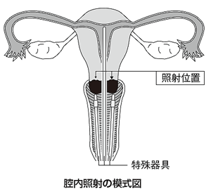 放射線療法