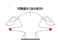 図：広汎子宮全摘術