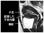 超音波検査で見つかった子宮体がん