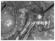 子宮体部にできたリンパ節転移巣