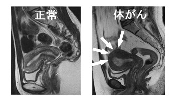 図：正常時と体がんを比べたMRI画像