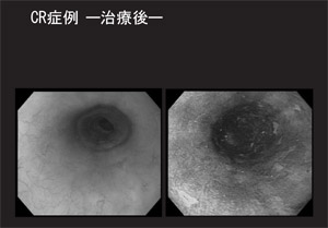 CR症例―治療後―