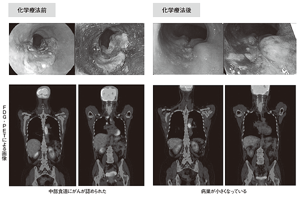 症例4 術前化学療法を行った患者さんの様子