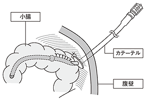 図5 空腸ろうとは?