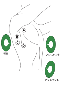 図：胸腔鏡下食道切除術における小開胸創の位置と術者の立ち位置）