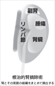 全摘と部分切除