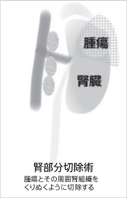 全摘と部分切除