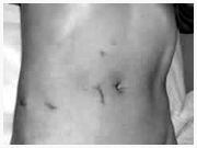 腹腔鏡の手術痕