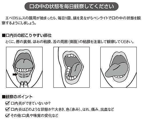 口内炎で気をつけるべきこと