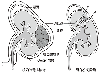 図6 腎がんの手術療法
