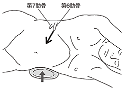 図7 腎部分切除の切除範囲