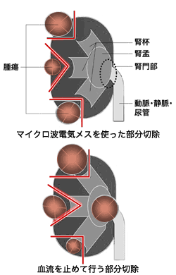 写真：腫瘍のタイプによる切除方法