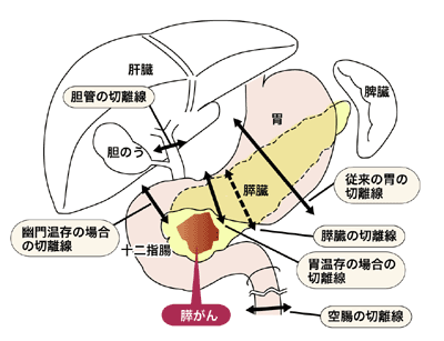 図:膵頭十二指腸切除術
