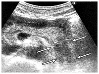 腹部超音波検査で明らかになった膵臓がん（矢印の部分）