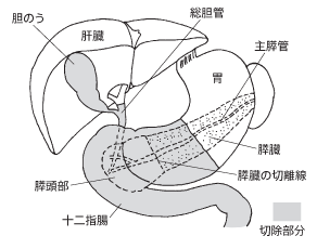 膵頭十二指腸切除術