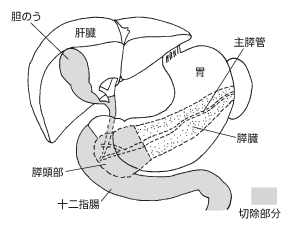 全胃幽門輪温存膵頭十二指腸切除術